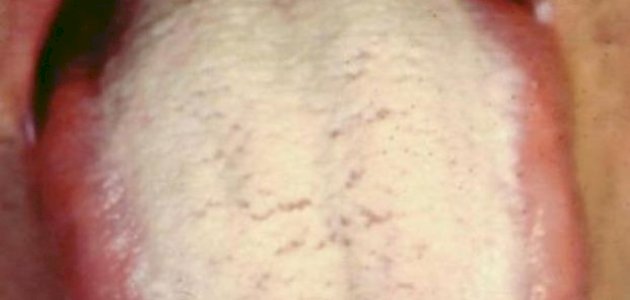 فطريات الفم واللسان صورة مقال فطريات الفم واللسان