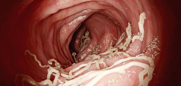 بحث عن دودة الأسكارس صورة مقال بحث عن دودة الأسكارس