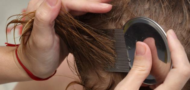 كيف ينتقل القمل من شخص لآخر صورة مقال كيف ينتقل القمل من شخص لآخر