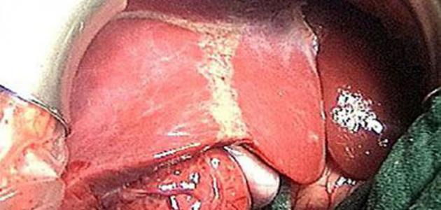 دهون الكبد وارتفاع الإنزيمات صورة مقال دهون الكبد وارتفاع الإنزيمات