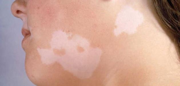 كيف يبدأ البهاق صورة مقال كيف يبدأ البهاق