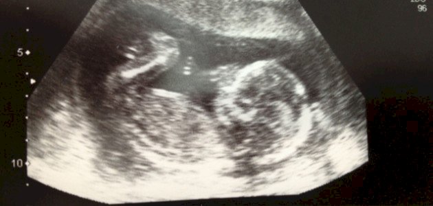 كيف شكل الجنين في الشهر الرابع صورة مقال كيف شكل الجنين في الشهر الرابع