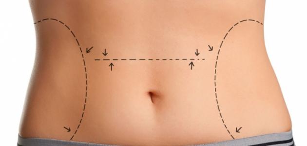 شفط البطن للداخل بعد الولادة صورة مقال شفط البطن للداخل بعد الولادة