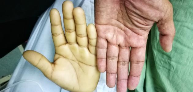 أعراض فقر الدم صورة مقال أعراض فقر الدم