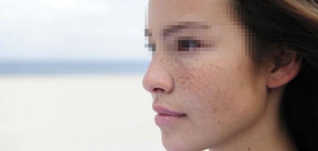 كيف أتجنب كلف الحمل صورة مقال كيف أتجنب كلف الحمل