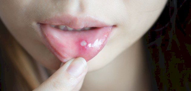 فطريات الفم عند الكبار صورة مقال فطريات الفم عند الكبار