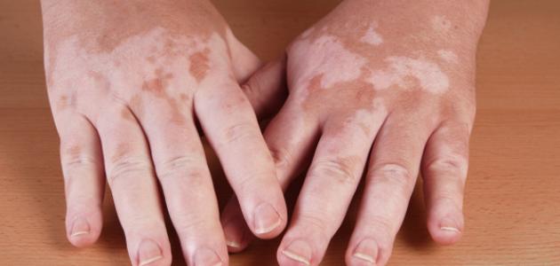 البهاق هل هو وراثي صورة مقال البهاق هل هو وراثي