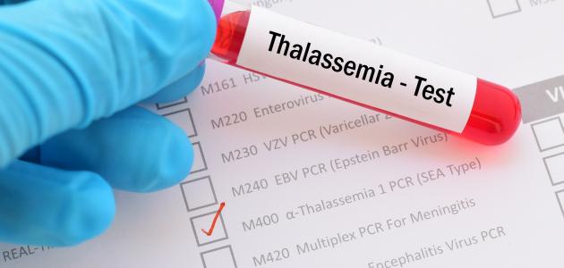 الثلاسيميا وفحوصات ما قبل الزواج صورة مقال الثلاسيميا وفحوصات ما قبل الزواج