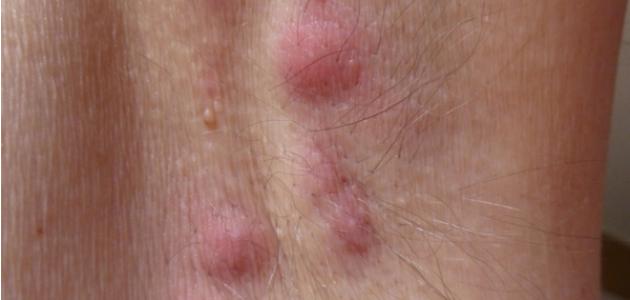 تورم الغدد الليمفاوية تحت الإبط صورة مقال تورم الغدد الليمفاوية تحت الإبط