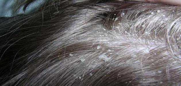 طريقه للتخلص من القشرة وتساقط الشعر صورة مقال طريقه للتخلص من القشرة وتساقط الشعر