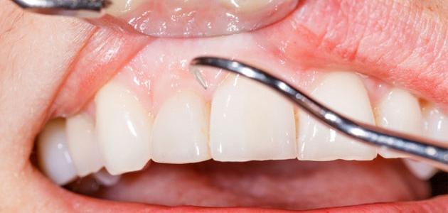 كيف أعالج لثتي من الالتهاب صورة مقال كيف أعالج لثتي من الالتهاب