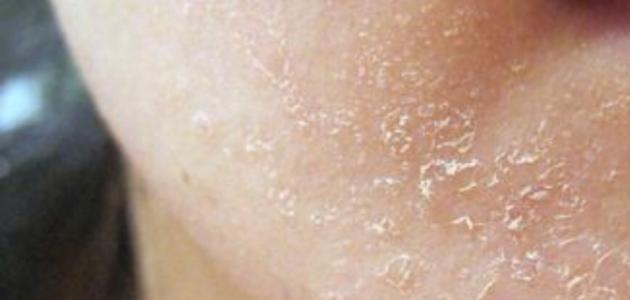 طريقة للتخلص من قشرة الوجه صورة مقال طريقة للتخلص من قشرة الوجه