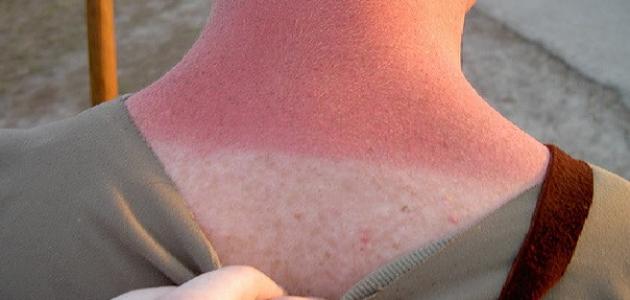 إزالة حروق الشمس منزلياً صورة مقال إزالة حروق الشمس منزلياً