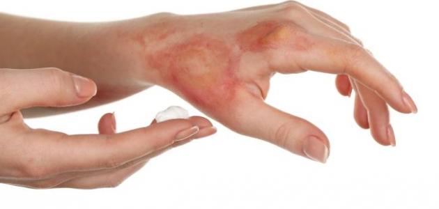 كيفية التخلص من آثار الحروق صورة مقال كيفية التخلص من آثار الحروق