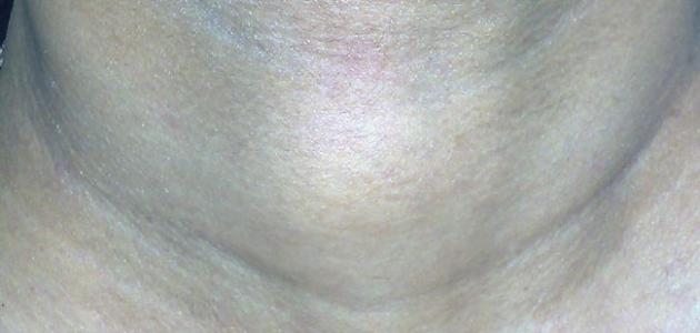 أعراض سرطان الغدة الدرقية صورة مقال أعراض سرطان الغدة الدرقية