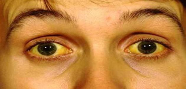 أسباب اصفرار العين صورة مقال أسباب اصفرار العين