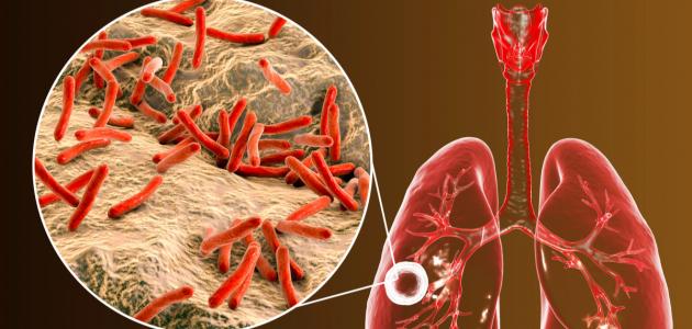 أسباب مرض السل صورة مقال أسباب مرض السل