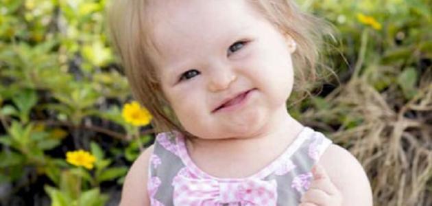 أسباب متلازمة داون صورة مقال أسباب متلازمة داون