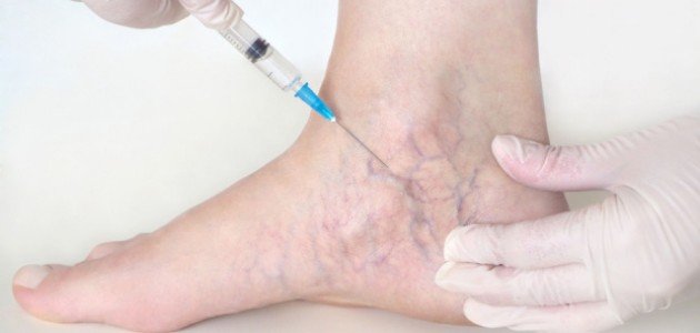 علاج الدوالي عند النساء صورة مقال علاج الدوالي عند النساء