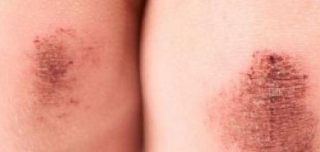 أنواع الجروح صورة مقال أنواع الجروح