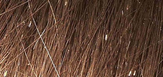 أضرار القمل صورة مقال أضرار القمل