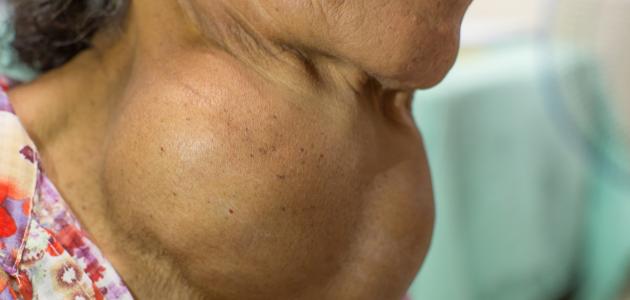 أسباب تضخم الغدة الدرقية صورة مقال أسباب تضخم الغدة الدرقية