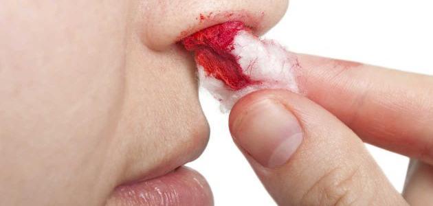 ما سبب نزول الدم من الأنف صورة مقال ما سبب نزول الدم من الأنف