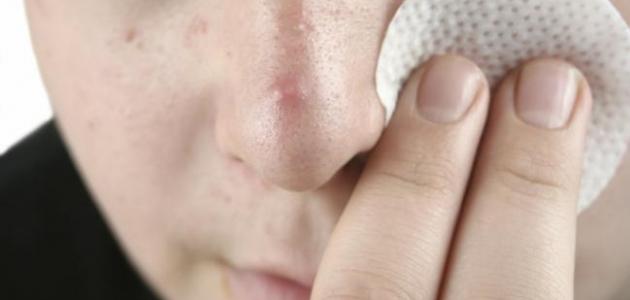 إزالة الرؤوس السوداء بالفازلين صورة مقال إزالة الرؤوس السوداء بالفازلين