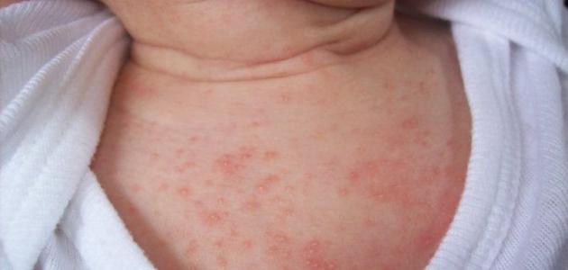 علاج الحساسية عند الأطفال صورة مقال علاج الحساسية عند الأطفال