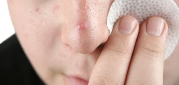 إزالة الرؤوس السوداء من الوجه صورة مقال إزالة الرؤوس السوداء من الوجه