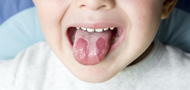أسباب التهاب اللسان صورة مقال أسباب التهاب اللسان