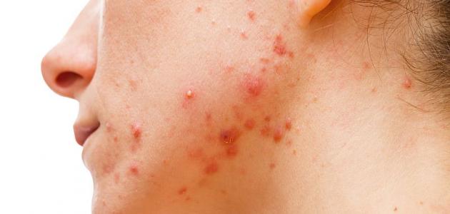 أسباب ظهور حب الشباب في الوجه صورة مقال أسباب ظهور حب الشباب في الوجه