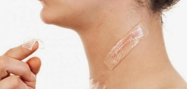 آثار الحروق القديمة صورة مقال آثار الحروق القديمة