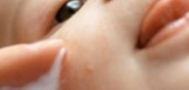 علاج حساسية الجلد عند الأطفال صورة مقال علاج حساسية الجلد عند الأطفال