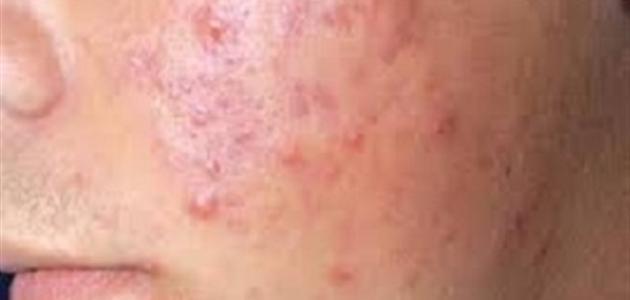 علاج حمو النيل عند الأطفال صورة مقال علاج حمو النيل عند الأطفال