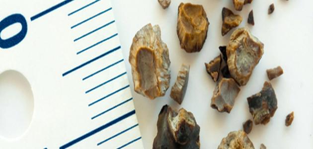 أعراض حصوة المثانة صورة مقال أعراض حصوة المثانة