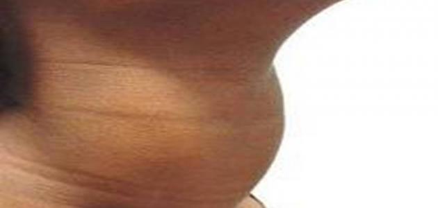 أعراض تضخم الغدة الدرقية عند النساء صورة مقال أعراض تضخم الغدة الدرقية عند النساء