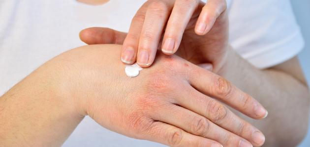 علاج الحساسية والحكة صورة مقال علاج الحساسية والحكة