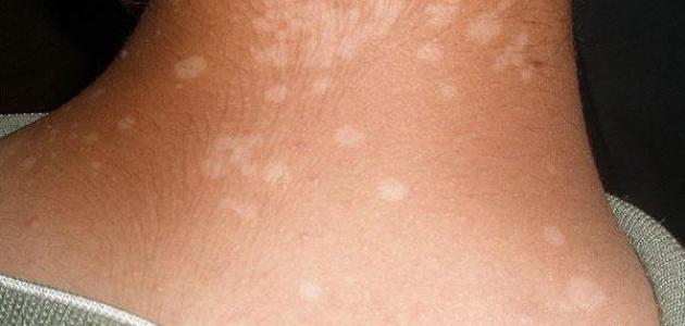 ظهور بقع بيضاء على الجلد صورة مقال ظهور بقع بيضاء على الجلد