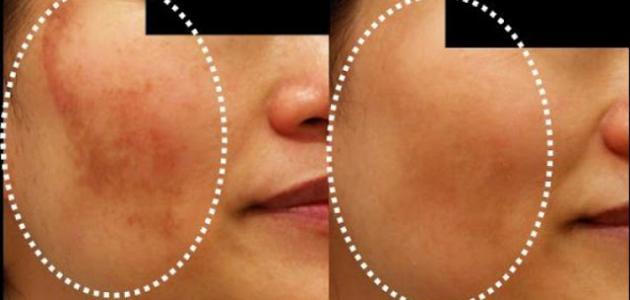 وصفة لإزالة الكلف من الوجه صورة مقال وصفة لإزالة الكلف من الوجه