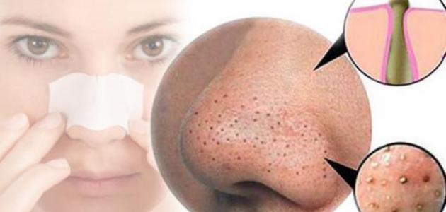 التخلص من الحبوب السوداء صورة مقال التخلص من الحبوب السوداء