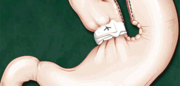 أضرار التكميم صورة مقال أضرار التكميم