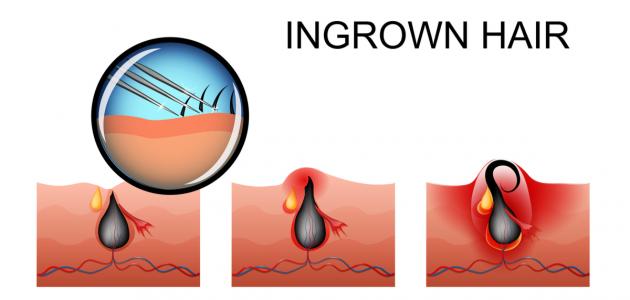 أسباب نمو الشعر تحت الجلد صورة مقال أسباب نمو الشعر تحت الجلد