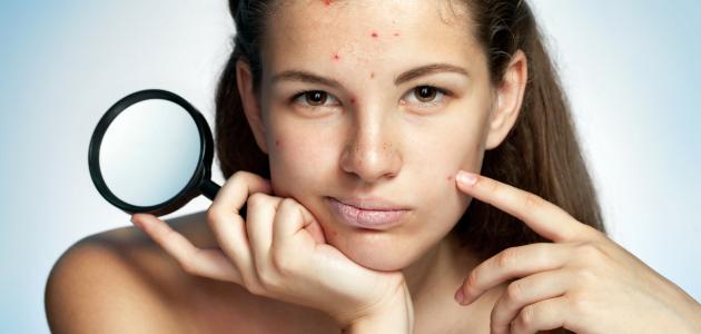 الحل النهائي لحب الشباب صورة مقال الحل النهائي لحب الشباب