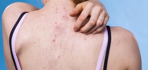 إزالة آثار الحبوب من الظهر صورة مقال إزالة آثار الحبوب من الظهر