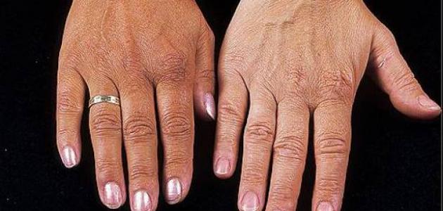 أسباب تغير لون الجلد صورة مقال أسباب تغير لون الجلد