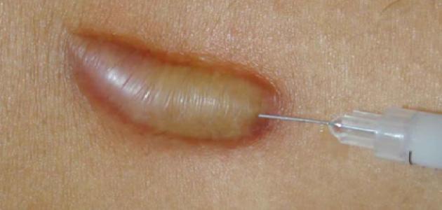 ما هي مضاعفات استخدام الكورتيزون الموضعي على الجلد صورة مقال ما هي مضاعفات استخدام الكورتيزون الموضعي على الجلد