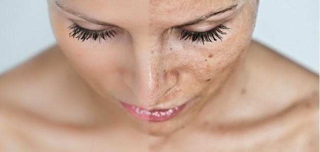 إزالة كلف الحمل صورة مقال إزالة كلف الحمل