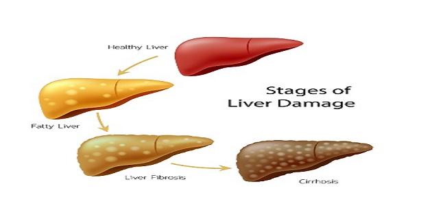 أعراض تشمع الكبد صورة مقال أعراض تشمع الكبد