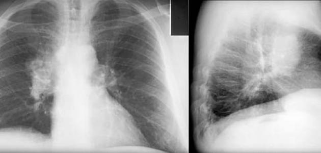 أسباب سرطان الرئة صورة مقال أسباب سرطان الرئة